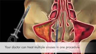 Balloon Sinus Dilation from Entellus [upl. by Zebulen]