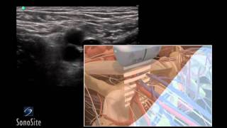 How To Ultrasound Guided Insertion of a Femoral Vein Catheter 3D Video [upl. by Eatnom]