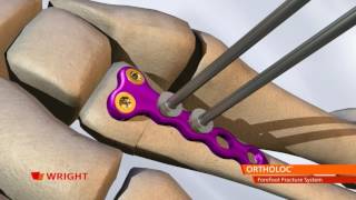 ORTHOLOC™ Forefoot Fracture System Animation [upl. by Laughry]