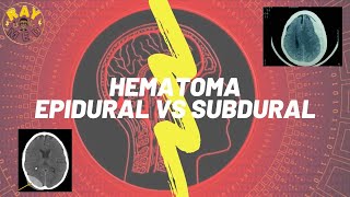 HEMATOMAS  EPIDURAL VS SUBDURAL [upl. by Haneeja881]