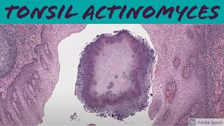 Tonsil Actinomyces 5Minute Pathology Pearls [upl. by Yenatirb773]