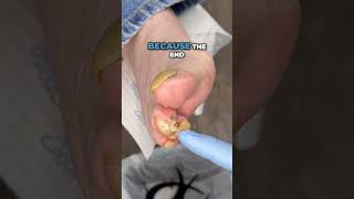 Helping my patient avoid FUNGUS in her feet Click the link to watch the full video [upl. by Zebedee]