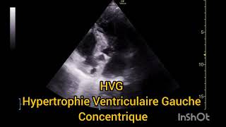 HVG Hypertrophie Ventriculaire Gauche Concentrique Échographie [upl. by Campball]