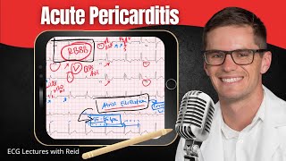 Acute Pericarditis amp Cardiac Tamponade EKG  ECG Lecture [upl. by Staffard]