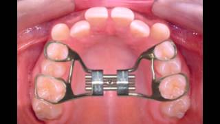 Rapid Palatal Expander [upl. by Ees290]