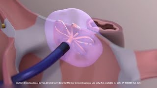 FARAPULSE™ Pulsed Field Ablation System Animation [upl. by Mcgean]