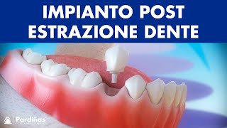 Impianto dentale immediato postestrazione dente © [upl. by Aselehc]