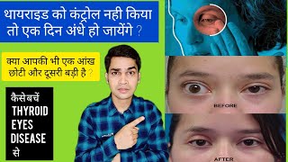 Thyroid Eye Disease  अगर आपकी आंख एक छोटी और दूसरी बड़ी है जानिए कारण Treatment [upl. by Eisiam305]