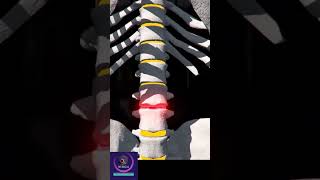 Spinal Cord Pain Management via Intrathecal pump [upl. by Akanke]