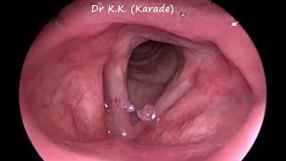 Video Laryngoscopy  How Vocal Polyp Look Like [upl. by Lewendal909]