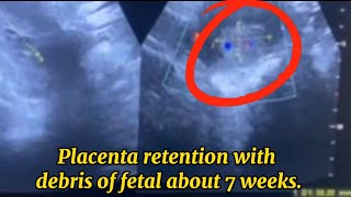 Placenta retention with debris of fetal about 7 weeks  Post medical abortion abdominal ultrasound [upl. by Rogerson]