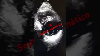 ANTEROSEPTAL FACE INFARCTION echocardiogram infarto anteroseptal [upl. by Harli103]