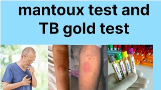 Mantoux test hindi main TB gold test hindi mainTB disease investigation [upl. by Jamey416]