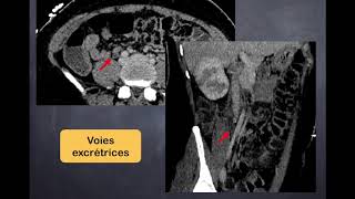 Infections urinaires  3 Pyélonéphrite aiguë  TDM [upl. by Nonah]