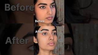 LIP HYPERPIGMENTATION Peeling off  Removal journey [upl. by Kristyn]