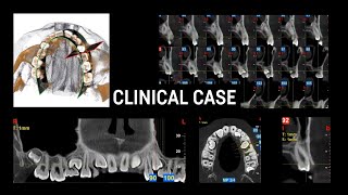 Clinical case  Deciduous dentition analysis [upl. by Alrats]