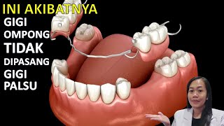 Ini akibatnya terlalu lama membiarkan gigi ompong tidak dipasang gigi palsu [upl. by Trojan541]