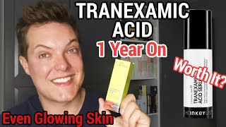 TRANEXAMIC ACID  12 Month Update  Did It Fade My Acne Scars [upl. by Torto]