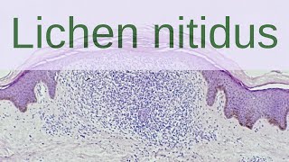 Lichen Nitidus  Pathology mini tutorials [upl. by Akinam]