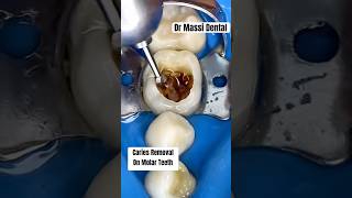 Caries Removal on Molar Teeth [upl. by Isnyl516]