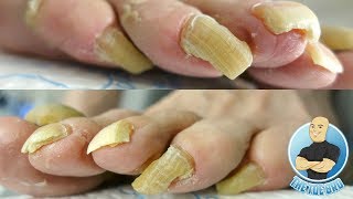 LONG TOENAILS FOR DAYS  TOENAIL CUTTING PART 1 [upl. by Euqinim623]