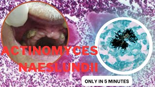 actinomyces microbiology lecture actinomyces naeslundii Easy Microbiology [upl. by Zirtaeb592]