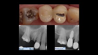 Extraction amp Implant placement with GBR Flap less [upl. by Bergen]