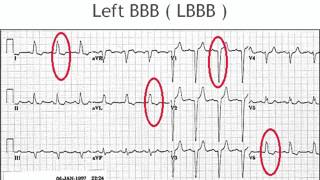 Bundle branch block chamber enlargement and bradyarrhythmias [upl. by Aerdnahs]