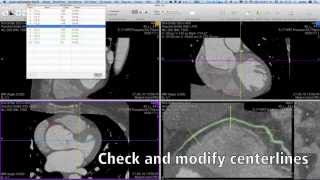 Cardiac CTA with OsiriX PRO [upl. by Atinrahs]