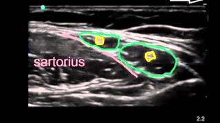 lateral femoral cutaneous nerve [upl. by Domini]