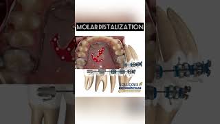 MINIMPLANT SUPPORTED MOLAR DISTALIZATION  ORTHODONTIC TIPS Shorts [upl. by Annod]