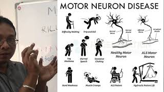 motor neurone diseaseamyotrophic lateral sclerosis [upl. by Garnett]