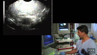 Mediastinal Mass vs Cyst  Dr Anand Sahai MD [upl. by Essie]