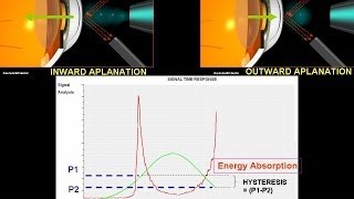 How does ocular response analyser works [upl. by Bahner936]