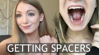 Getting Spacers for Braces  My Experience [upl. by Odlabu]