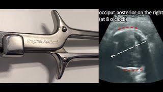 Seeing is believing Kiellands Forceps Rotation under Ultrasound [upl. by Anya867]