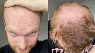 Going Bald In My Early 20s  How I Accepted Balding [upl. by Nodanrb298]