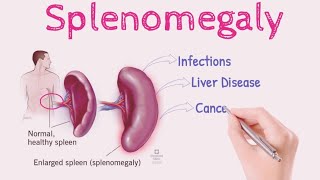 Splenomegaly OR Enlarged Spleen  Sign and Symptoms  Causes  Risk Factors  Treatment [upl. by Frieda]