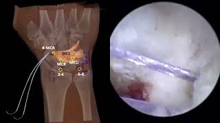 Arthroscopic Midcarpal Suture Anchor Repair of Dorsal Intercarpal Ligament Avulsion [upl. by Amis253]