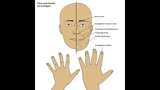 Acromegaly definition amp Meaning Health Healthcare Healthtips [upl. by Aizan945]