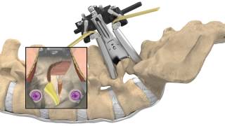 MAS® TLIF Patient Animation [upl. by Jaal]