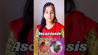 Ascariasis  protozoan disease🦠causes symptoms  transmission ascaris neet biology shortvideo [upl. by Allimak450]