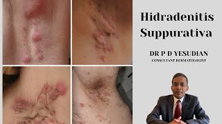 Hidradenitis suppurativa  pathogenesis and management [upl. by Rigdon]