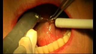 LÁSER EN DENTAL EN TEJIDOS BLANDOS papiloma lingual [upl. by Shuping]