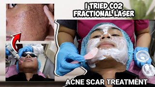 ACNE SCAR TREATMENT I TRIED CO2 FRACTIONAL LASER  SUBCISION FOR ACNE SCARS [upl. by Lorine600]