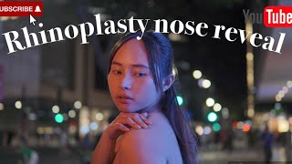 Worth it ba Nose RevealBest Doctor in the Philippines Rhinoplasty Journey Doc Joyce Regalado [upl. by Eijneb432]