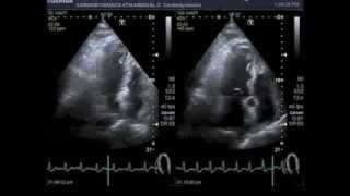 Bicycle stress echocardiography [upl. by Mitchael610]