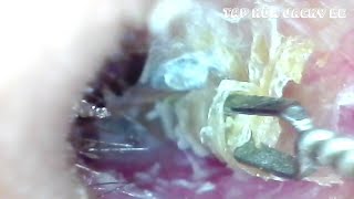 Ear Wax Removal 13  Ear Cleaning ASMR  Video Relaxing [upl. by Anirrok854]