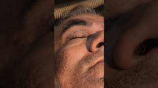 Extraction of senile periorbital comedones dr Bhutada Skin India [upl. by Sato]