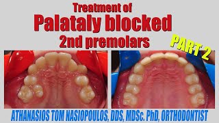 Treatment of Palataly Blocked 2nd Premolars Part 2  Athanasios Tom Nasiopoulos [upl. by Beulah]